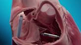 The new ‘no surgery, no wires’ pacemaker