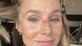 Kristen Bell Shares Photos from Jiu-Jitsu Injury Caused by Daughter: 'You Should See the Other Guy'