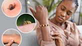 Warning over 4 common bug bites - and when to seek urgent medical help