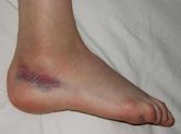 Sprain