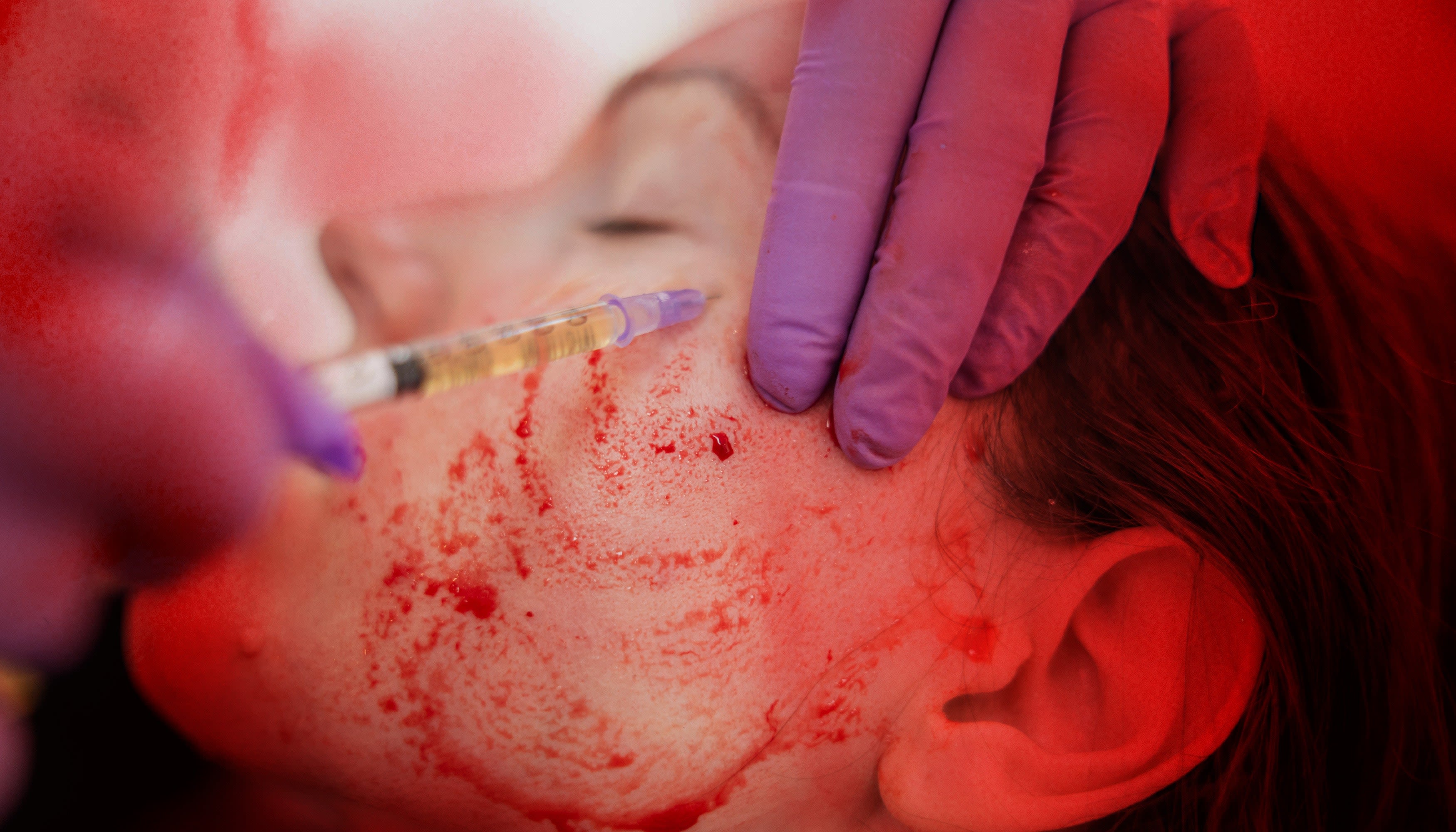 What Exactly Are PRP Facial Treatments?