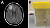 Extraen del cerebro de una australiana una lombriz intestinal viva de 8 centímetros