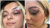 Bebe Rexha shows off injuries after getting hit in the face with a phone at her New York concert