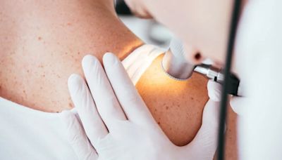 Día mundial contra el melanoma, el responsable del 75% de las muertes por cáncer de piel
