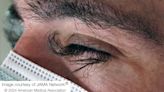 Chemo side effect caused man's eyelash growth to go haywire