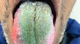 A man's tongue turned green and hairy after he took antibiotics