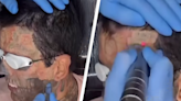 Man shows how he gets his entire face tattoo removed by laser but everyone is pointing out one thing