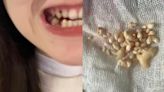 陸23歲女從小缺顆牙！醫一查嚇壞 「一次狂挖57顆牙」