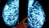 'Lack of action' before breast screening concerns
