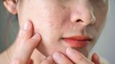 10 Best Ingredients for Acne, According to Dermatologists