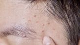 What Is Folliculitis?