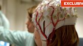 Surgery for children with epilepsy boosts cognitive ability, quality of life and IQ