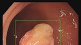 大腸裡滿滿瘜肉！醫揪1.2公分早期大腸癌瘜肉 外觀有菱角、周圍明顯雞皮