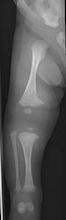 Osteogenesis imperfecta