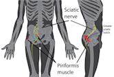 Piriformis syndrome