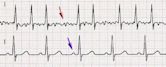 Atrial fibrillation