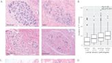 Testosterone therapy may protect against breast cancer in trans masculine individuals