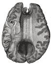 Corpus callosum