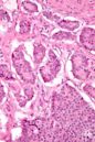 Neuroendocrine tumor