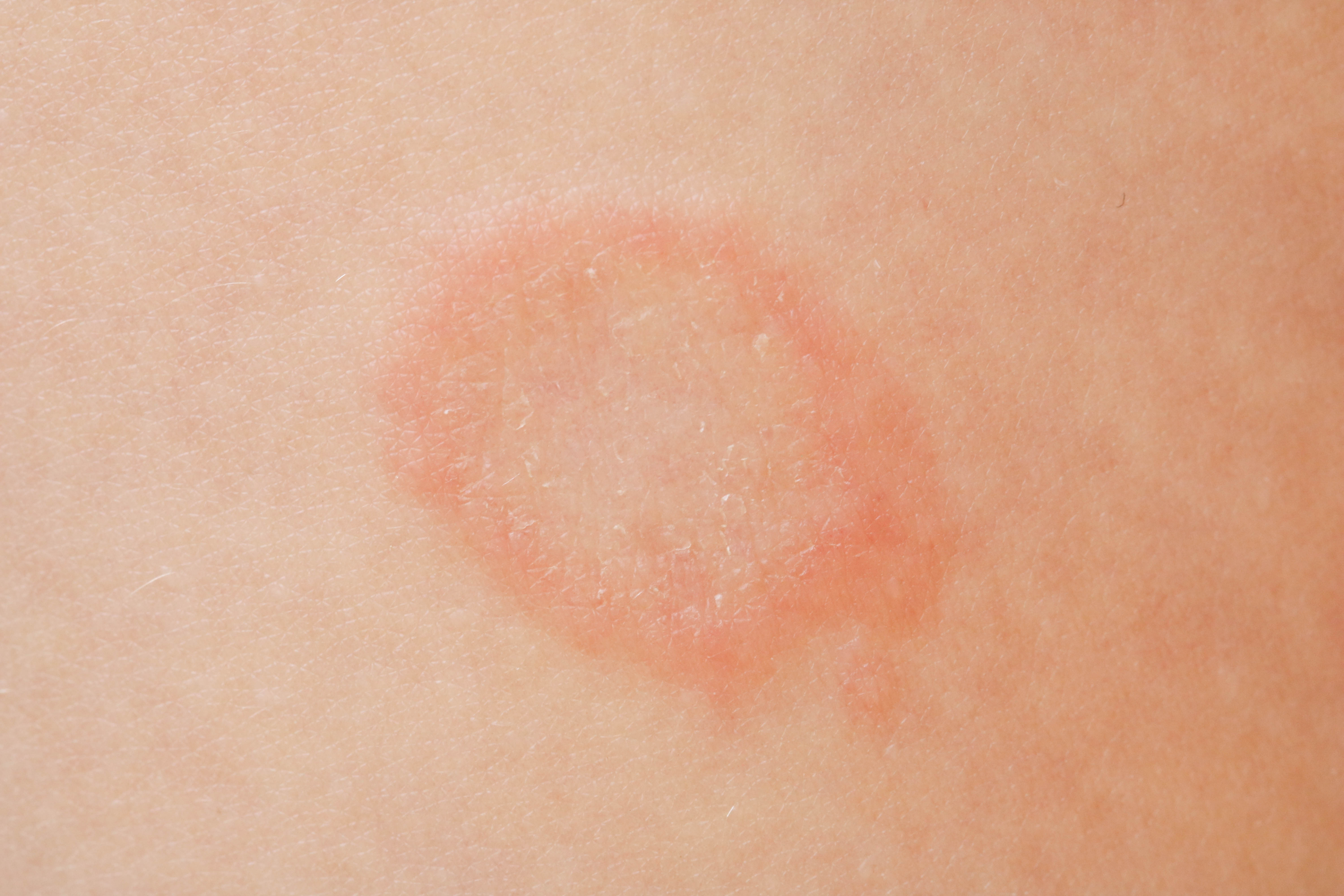 Highly contagious form of sexually transmitted ringworm reported in the US for the 1st time