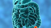 Researchers developing new colon cancer tests amid rising cases