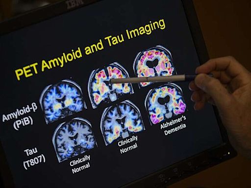 New Alzheimer’s blood tests show promise | Northwest Arkansas Democrat-Gazette