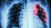 AI can help predict whether a patient will respond to specific tuberculosis treatments, paving way for personalized care