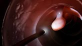 Colonoscopy is still the most recommended screening for colorectal cancer, despite conflicting headlines and flawed interpretations of a new study