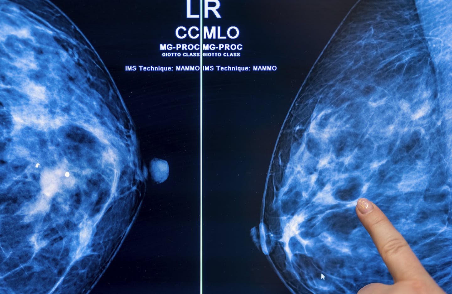 Breast density and mammograms: New FDA rule will ensure all women have more information after cancer screenings