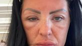 'My face swelled so badly on holiday I didn't think I'd get through passport control'