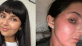 Woman clears skin condition that left her unable to sleep with ‘unbelievable’ £7.99 fix