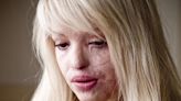 Decision to free Katie Piper acid attack stalker to be made next month