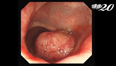 大便有血是痔瘡或息肉？老翁腸息肉掉出肛門以為是痔瘡 檢查竟是大腸癌