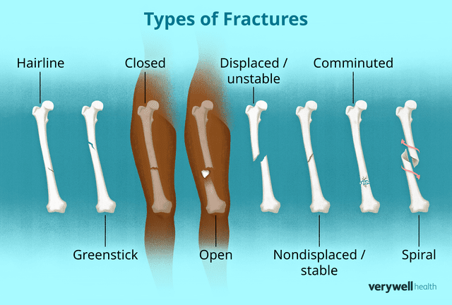 Fracture: What to Know About This Injury