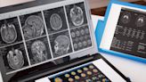 En la UBA: entrenan a una Inteligencia Artificial para que pueda reconocer el inicio del Alzheimer a través de resonancias magnéticas