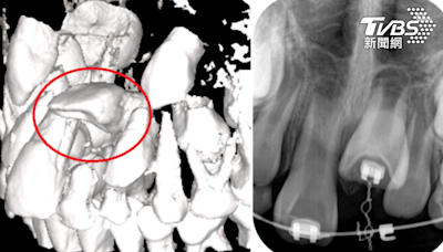 講話漏風！9歲童沒門牙不敢上學 醫一看竟「包在牙齦裡」