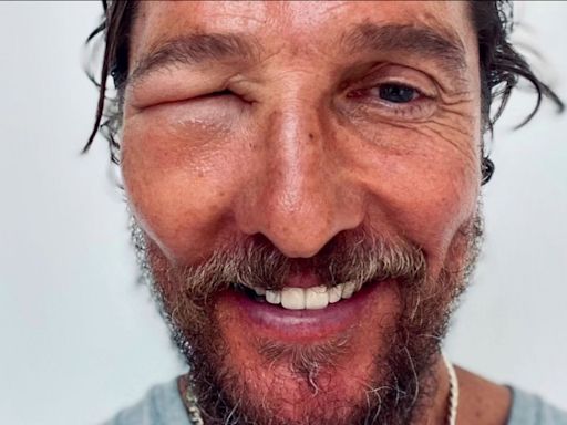 Matthew McConaughey’s face horrifically swollen by bee sting