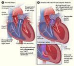 Congenital heart defect