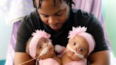 Conjoined twin girls are successfully separated in rare surgery
