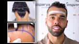 Arsenal star David Raya shows off new look after undergoing hair transplant