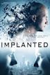 Implanted