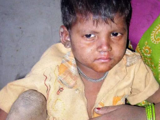 India's future being gutted: Congress slams govt over child malnutrition