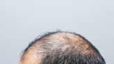 Shortage of drug that treats thinning hair is a 'significant problem,' doctors say