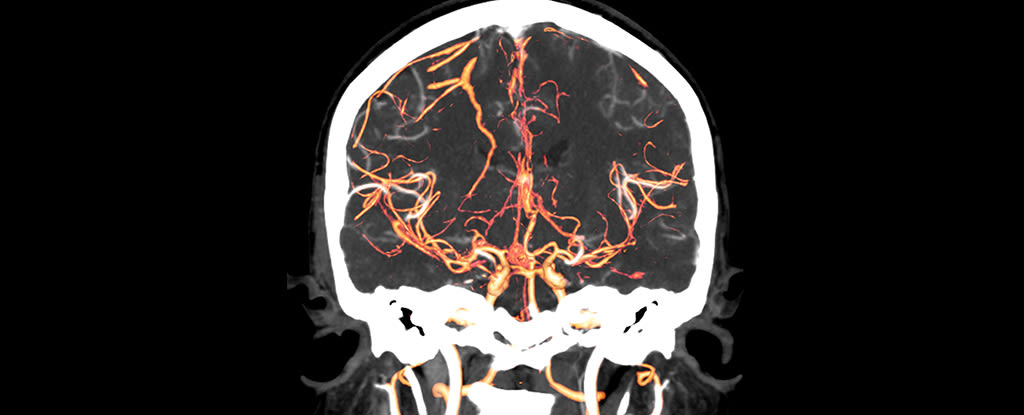 The Starting Point of Schizophrenia May Have Been Found in Brain Scans