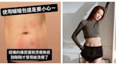 依依經痛嘔吐 她用暖暖包熱敷「燙傷一片紅色疤痕」