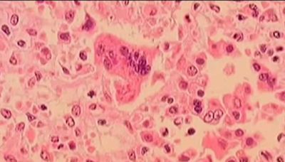 2 measles cases in New England linked to international traveler