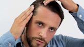 Minoxidil nos cabelos: versão em comprimido tem o mesmo efeito