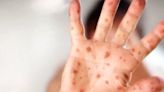 Health officials confirm measles case in Vermont