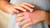 Crean piel sintética para personas con problemas de dermatitis atópica