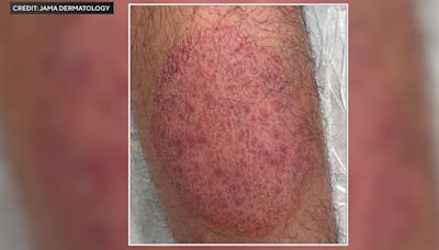 New sexually transmitted form of ringworm reported in NYC. Here's what you need to know.